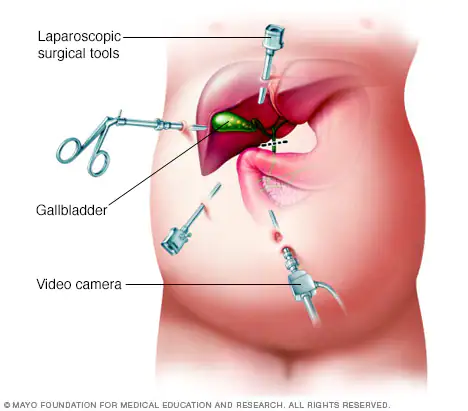 gallbladder surgery cost in bangalore